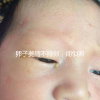 卵子萎縮不排卵,閉鎖卵泡形成原因與這4點有關