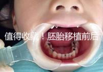 值得收藏!胚胎移植前后這些注意事項都應該知道