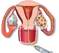 一代二代三代試管嬰兒有什么區(qū)別？