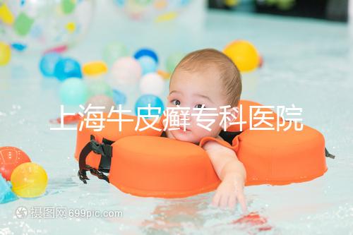 上海牛皮癬?？漆t院