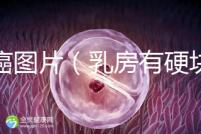 乳癌圖片(乳房有硬塊的位置圖片)