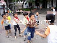 濕疹(濕疹長什么樣子圖片)