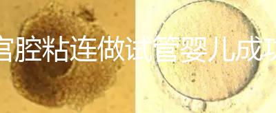 宮腔粘連做試管嬰兒成功率普遍很低?并不會(huì)具體要看癥狀