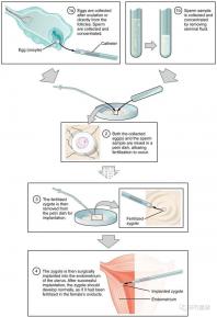 試管嬰兒移植手術(試管嬰兒移植手術需要多長時間)