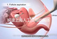 解讀上海人工授精的具體過(guò)程,會(huì)不會(huì)痛看醫(yī)生怎么說(shuō)?