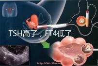 TSH高了，FT4低了，需要補碘嗎？